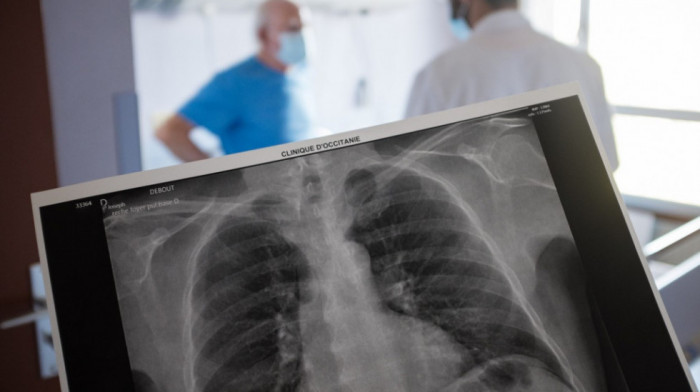 Beogradski pulmološki dani:  U Srbiji svaka sva sata jedna osoba premine od karcinoma pluća